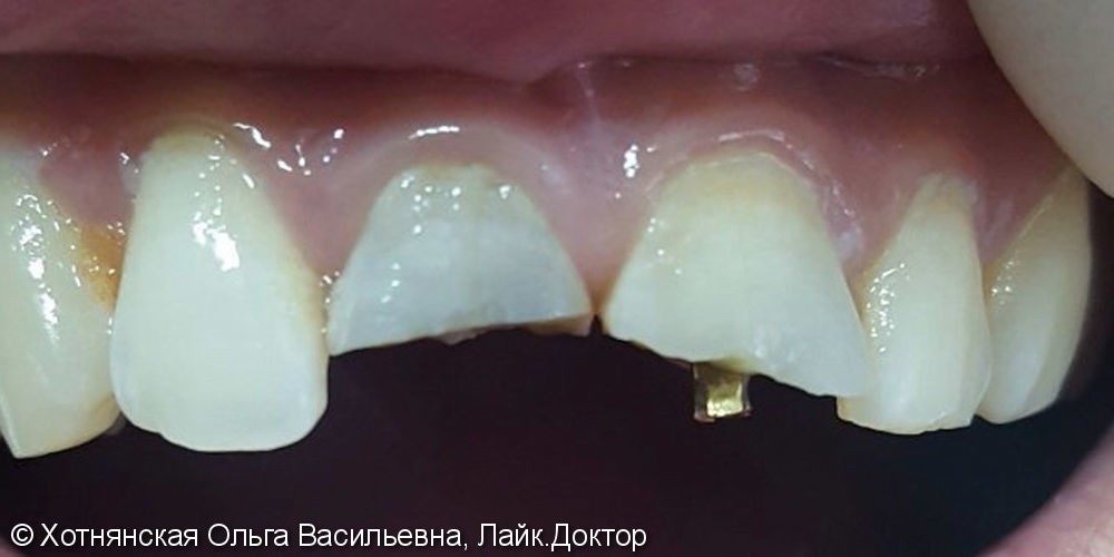 Результат эстетической реставрации центральных зубов за одно посещение - фото №1