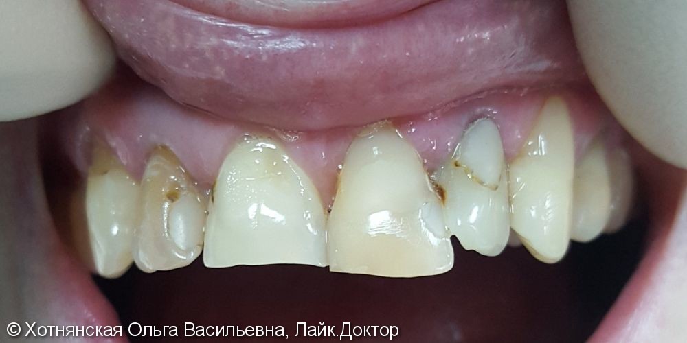 Результат эстетической реставрации 6-ти центральных зубов - фото №1