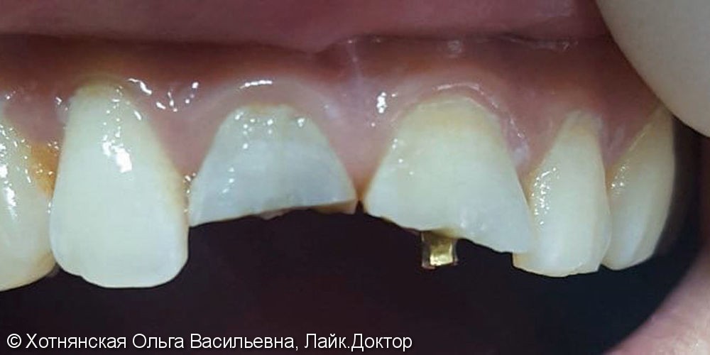 Результат реставрации 2-х центральных зубов - фото №1