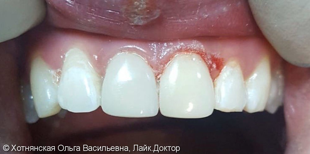 Результат реставрации 2-х центральных зубов - фото №2