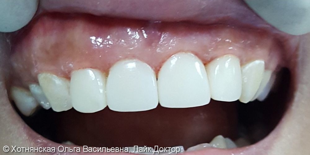 Результат реставрации 4-х зубов за 2 посещения - фото №2