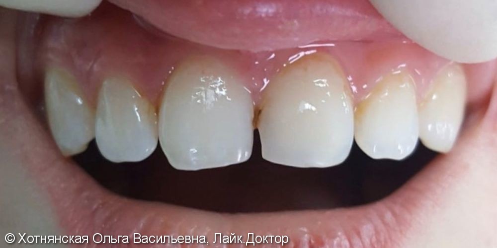 Исправление диастемы (щель между центральными зубами) - фото №1