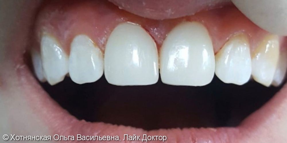 Исправление диастемы (щель между центральными зубами) - фото №2