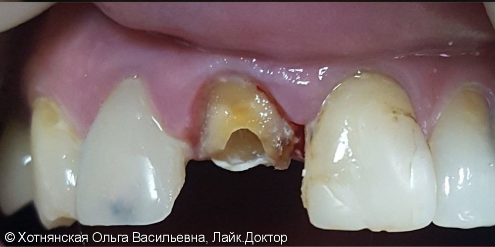 Эстетическая реставрация 4-х центральных зубов - фото №2