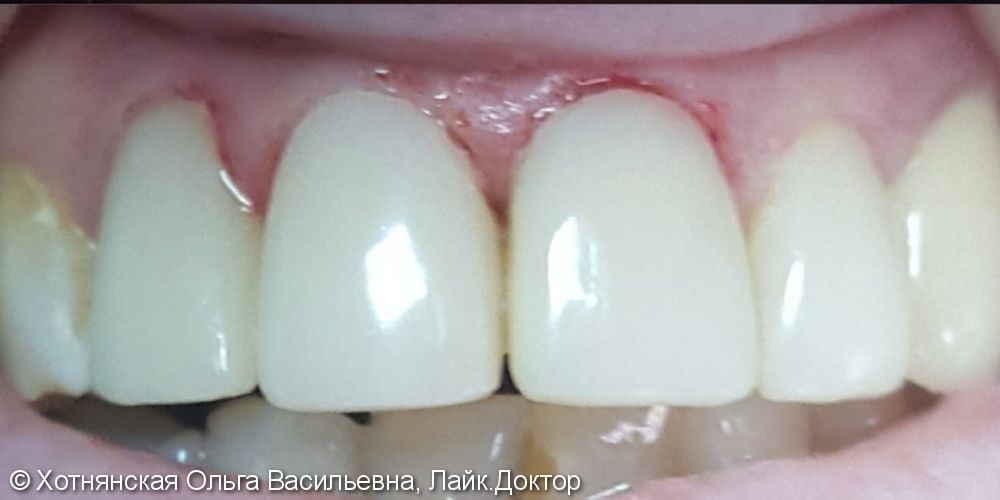 Эстетическая реставрация 4-х центральных зубов - фото №3