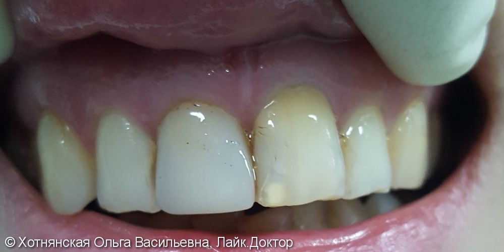 Реставрированы 2 центральных зуба, результат на фото после - фото №1