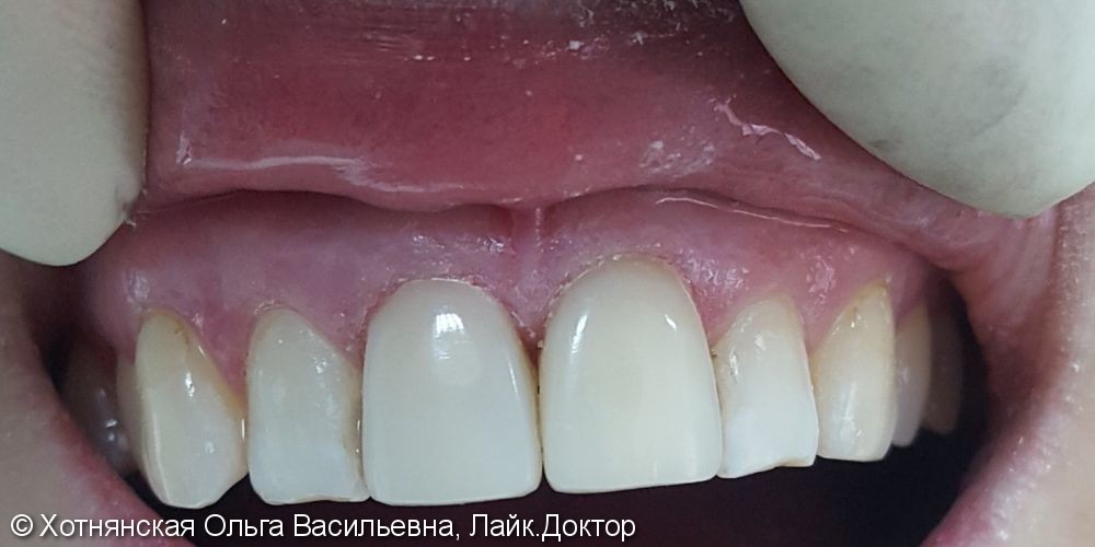Реставрированы 2 центральных зуба, результат на фото после - фото №2