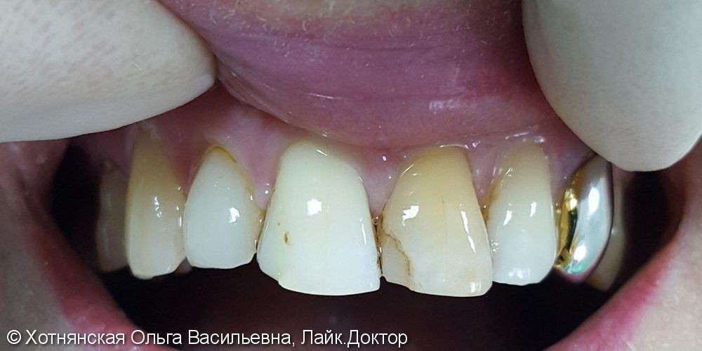 Эстетическая реставрация 2-х центральных зубов очень быстро и недорого - фото №1