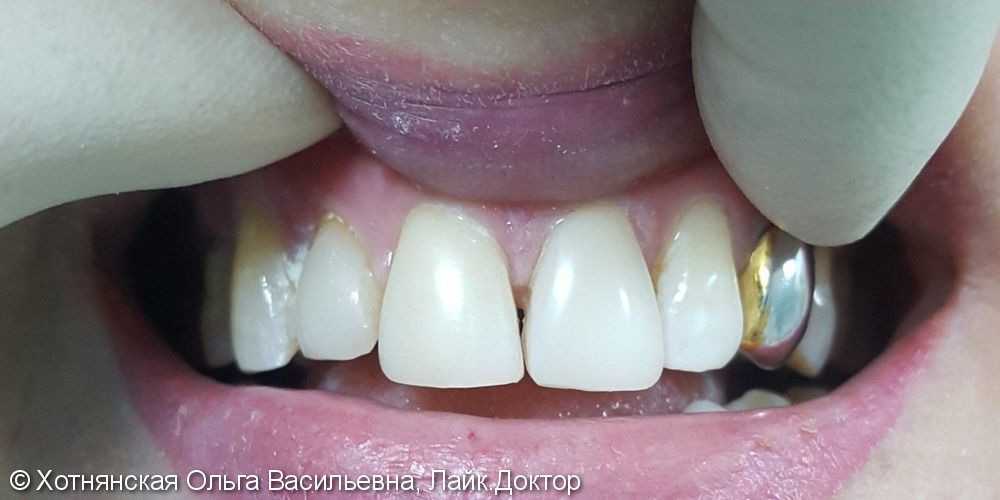 Эстетическая реставрация 2-х центральных зубов очень быстро и недорого - фото №2