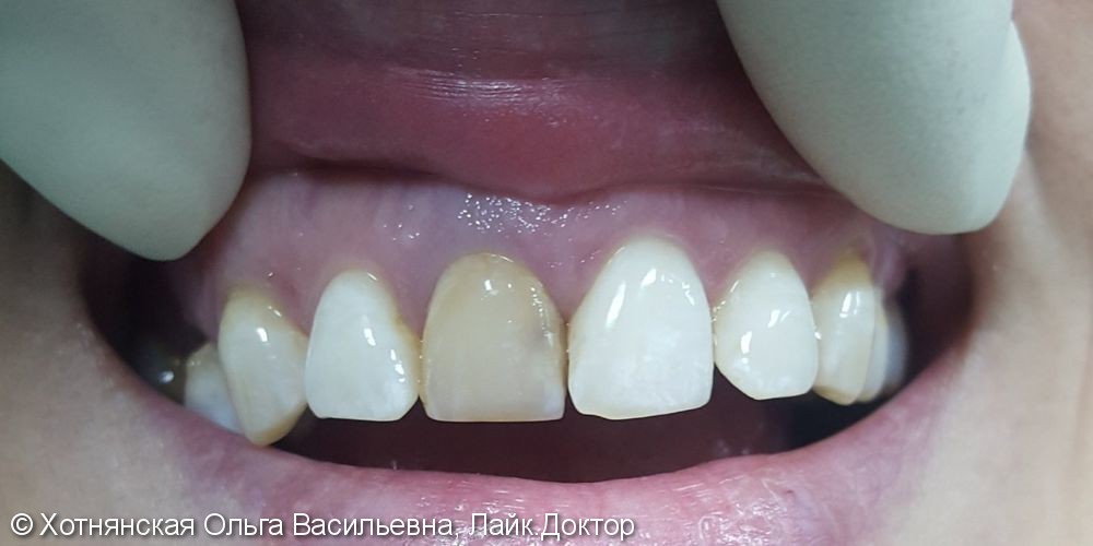 Эстетическая реставрация зуба, который не возможно было отбелить внутриканальным отбеливанием - фото №1