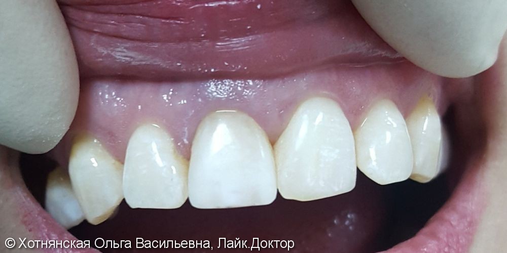 Эстетическая реставрация зуба, который не возможно было отбелить внутриканальным отбеливанием - фото №2