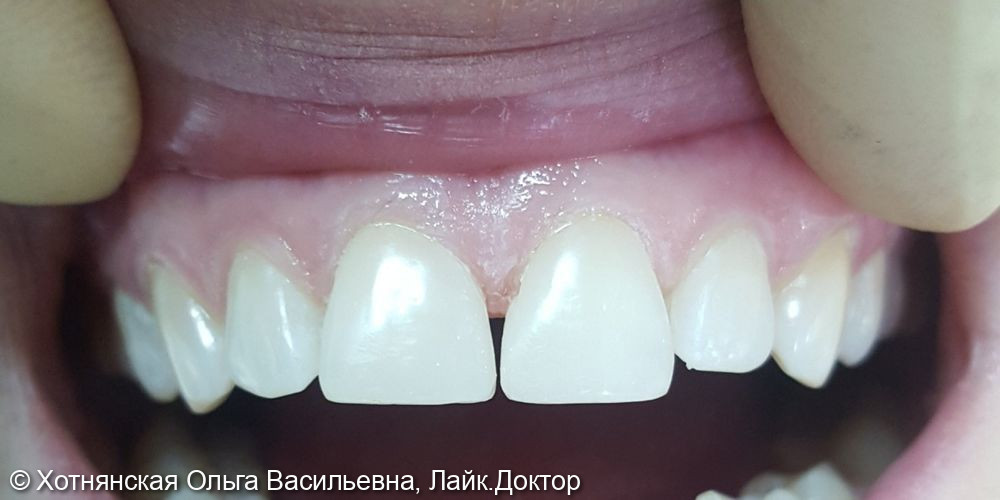 Реставрация 2-х зубов за одно посещение - фото №2