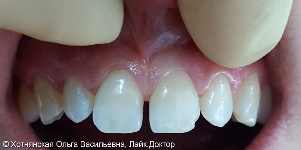 Эстетическая реставрация центральных зубов, июль 2020 - фото №1