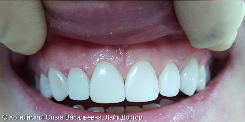 Эстетическая реставрация центральных зубов, июль 2020 - фото №2