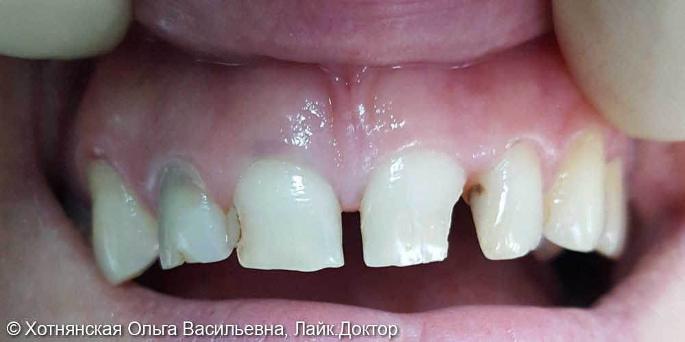 Реставрация 4-х центральных зубов, уменьшение диастемы - фото №1