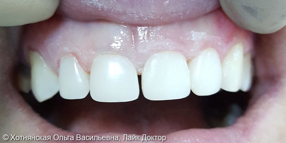 Реставрация 4-х центральных зубов, уменьшение диастемы - фото №2