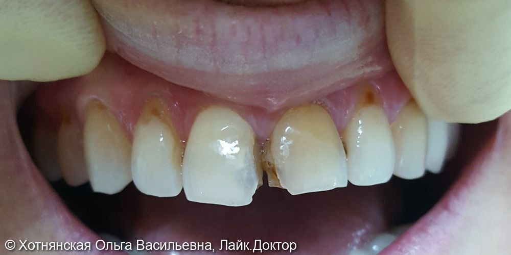 Реставрация 5-ти центральных зубов - фото №1