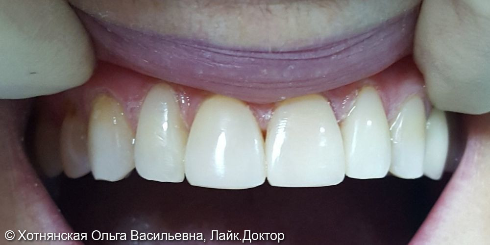 Реставрация 5-ти центральных зубов - фото №2