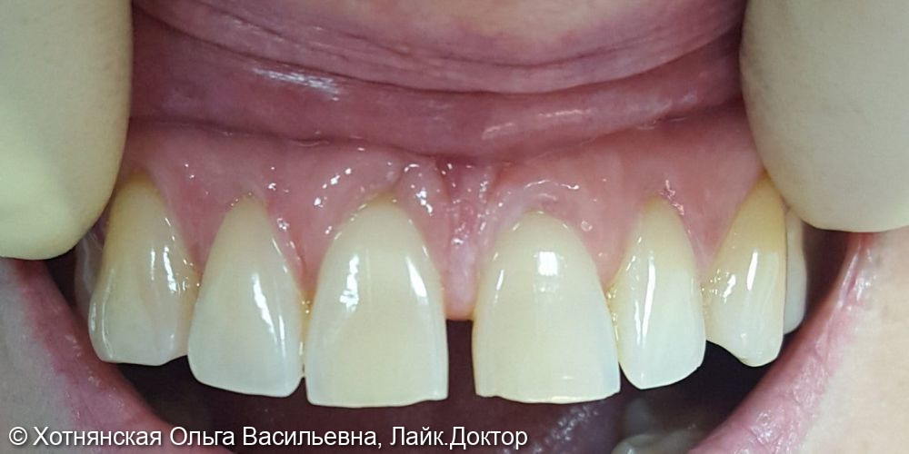 Устранена диастема (щель между зубами) путём эстетической реставрации 2-х центральных зубов - фото №1