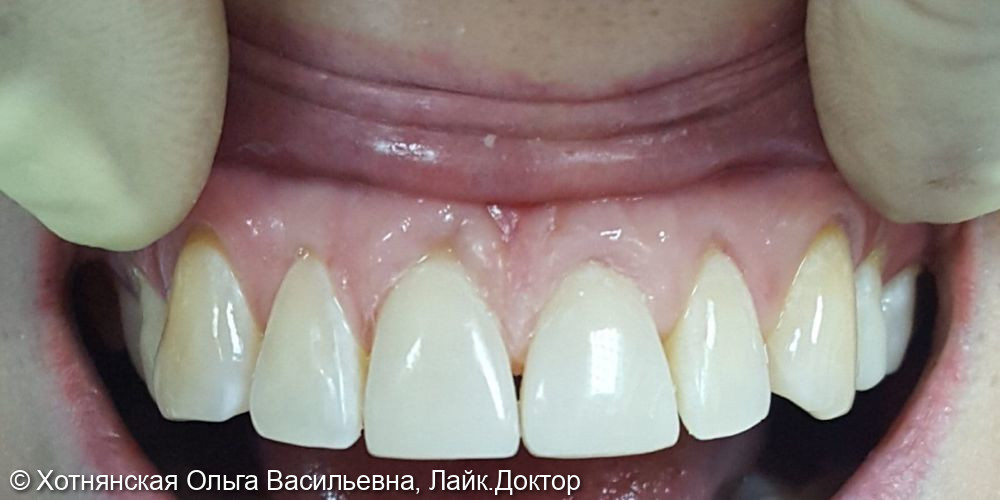 Устранена диастема (щель между зубами) путём эстетической реставрации 2-х центральных зубов - фото №2