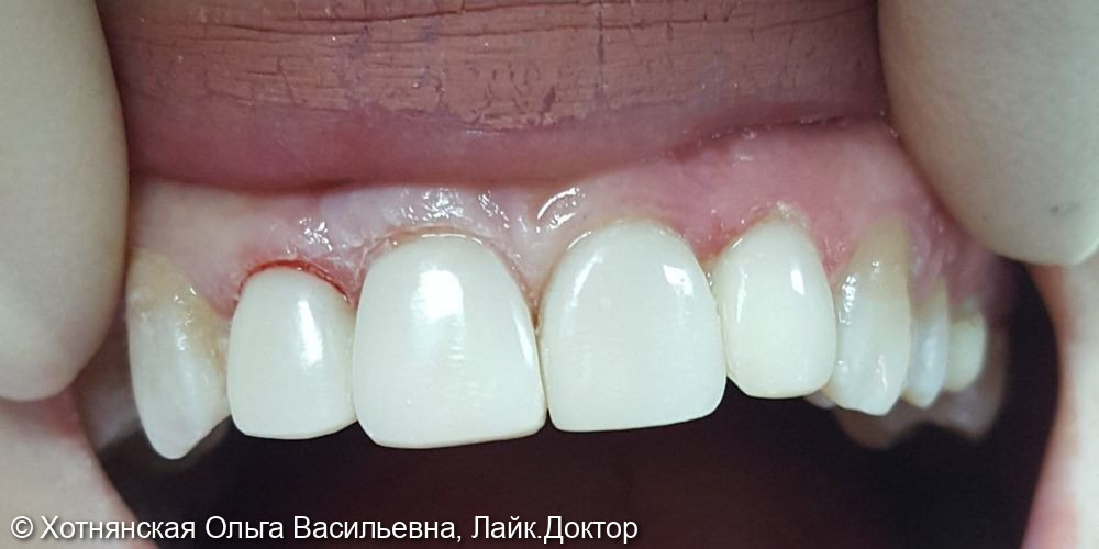 Эстетическая реставрация центральных зубов - фото №2