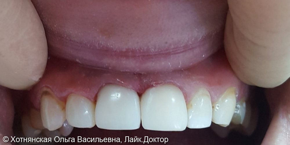 Эстетическая реставрация центральных зубов - фото №2