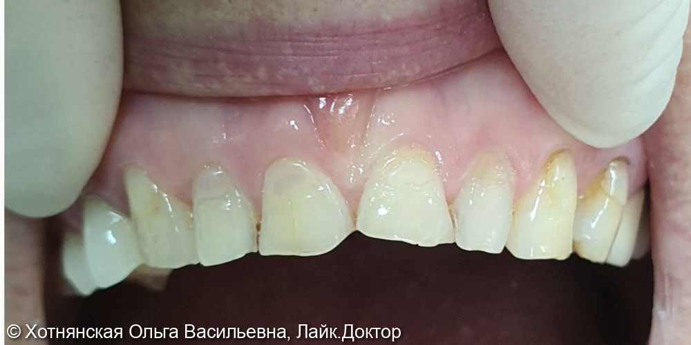 Реставрация 7 центральных зубов была проведена девушке из ГЕРМАНИИ - фото №1