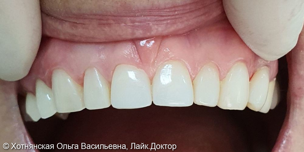 Реставрация 7 центральных зубов была проведена девушке из ГЕРМАНИИ - фото №2