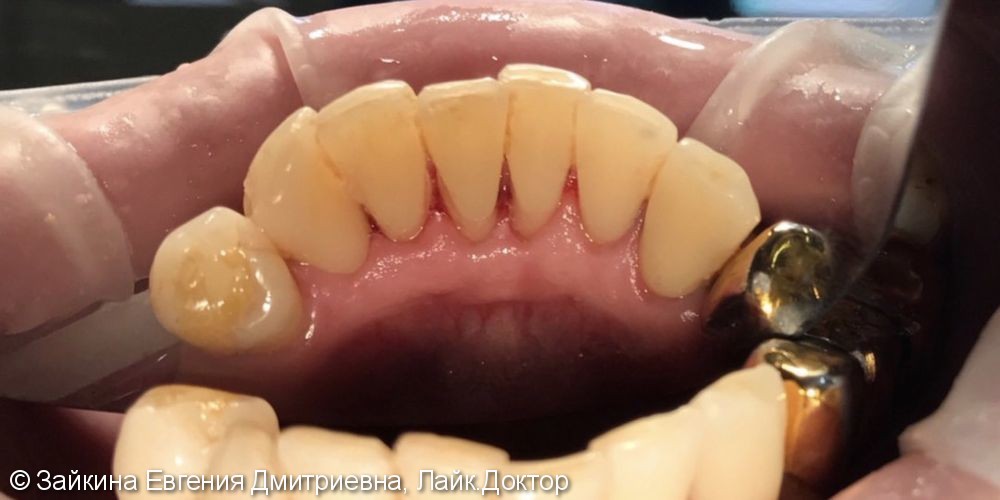 Профессиональная гигиена полости рта, до и результат после - фото №2
