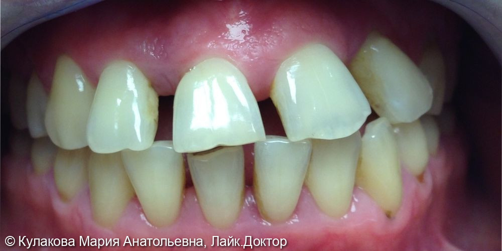 Ортодонтическое лечение - фото №1