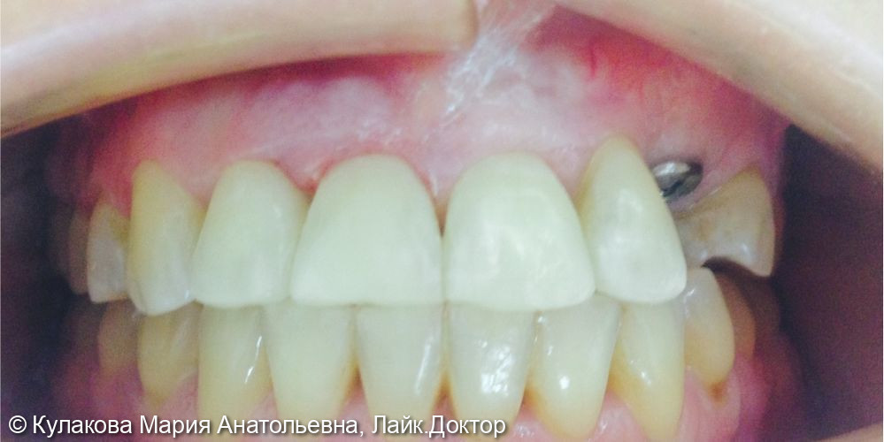 Ортодонтическое лечение - фото №2