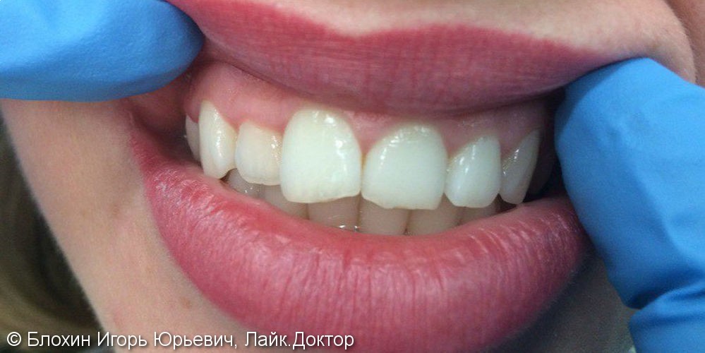 Установка 4 виниров на передние зубы, до и после - фото №1