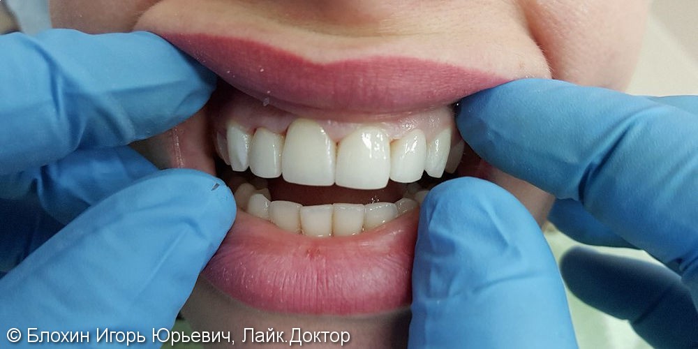 Установка 4 виниров на передние зубы, до и после - фото №2