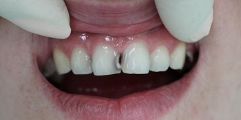 Лечение среднего кариеса 11 зуба с последующей реставрацией - фото №1