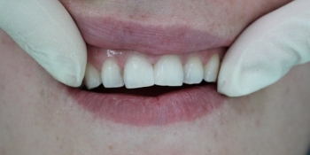 Лечение среднего кариеса 11 зуба с последующей реставрацией - фото №2