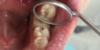 Результат лечения кариеса 35го зуба - фото №1