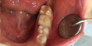 Результат лечения кариеса 35го зуба - фото №2