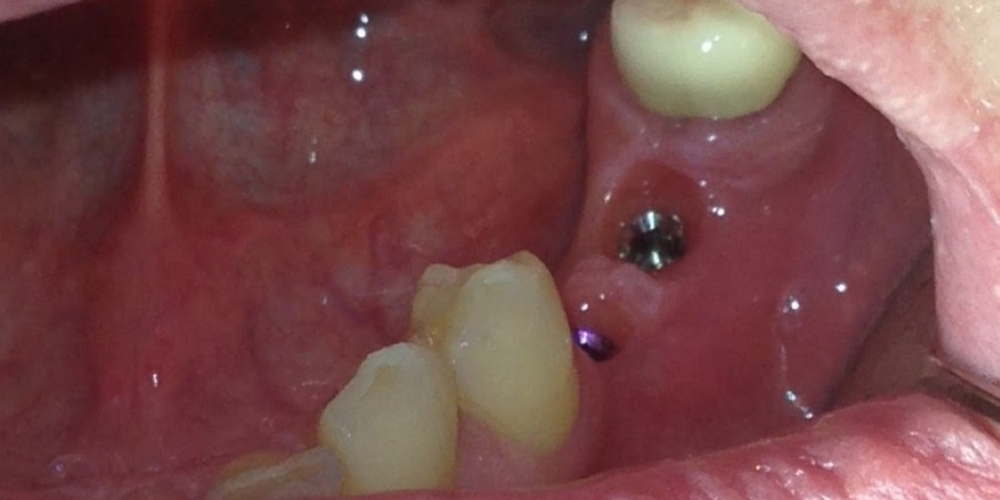 Восстановление отсутствующих зубов коронками на имплантах - фото №1
