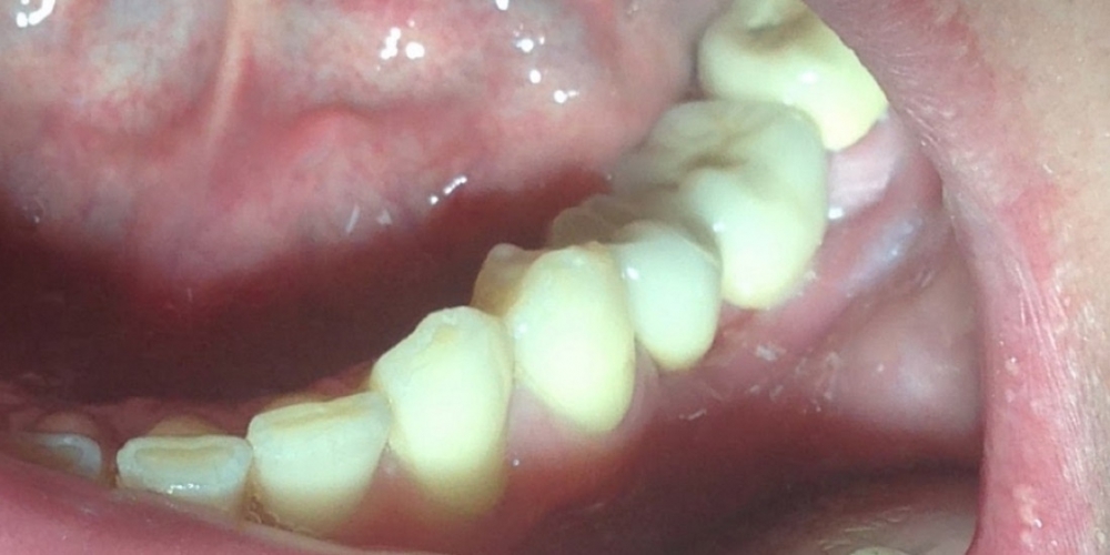 Восстановление отсутствующих зубов коронками на имплантах - фото №2
