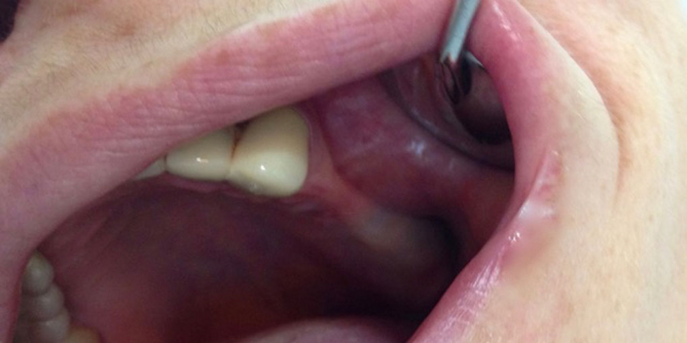 Имплантация и протезирование трех зубов на имплантах - фото №1