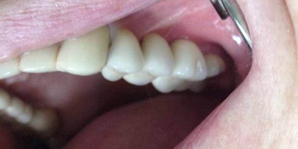 Имплантация и протезирование трех зубов на имплантах - фото №2