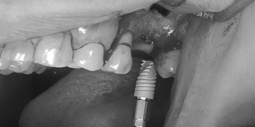 Вам интересно, как выглядит зубной имплант? - фото №1