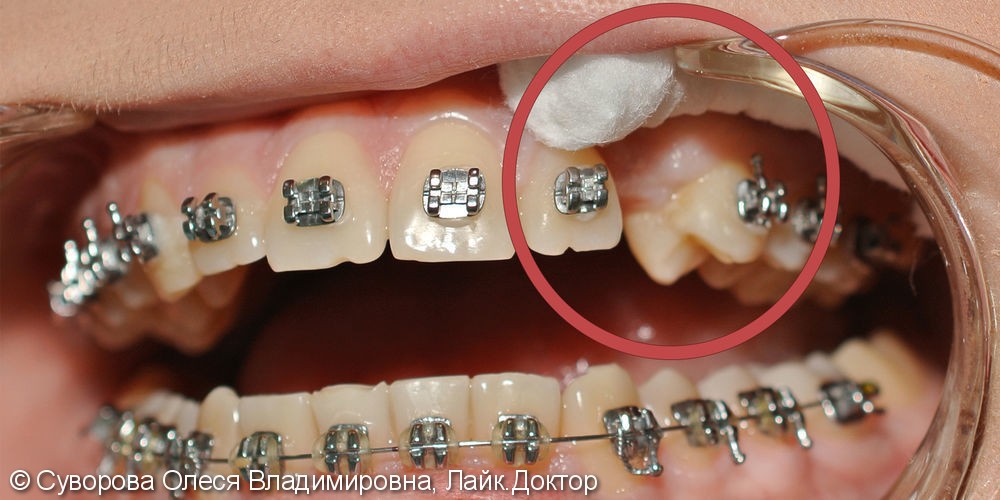 Постановка ретинированного (непрорезавшегося) зуба в зубной ряд брекетами - фото №1