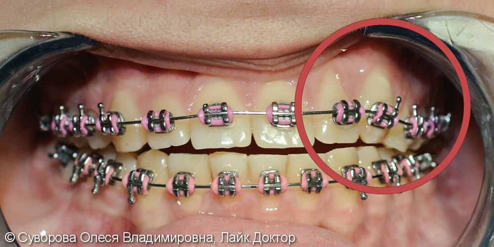Постановка ретинированного (непрорезавшегося) зуба в зубной ряд брекетами - фото №2