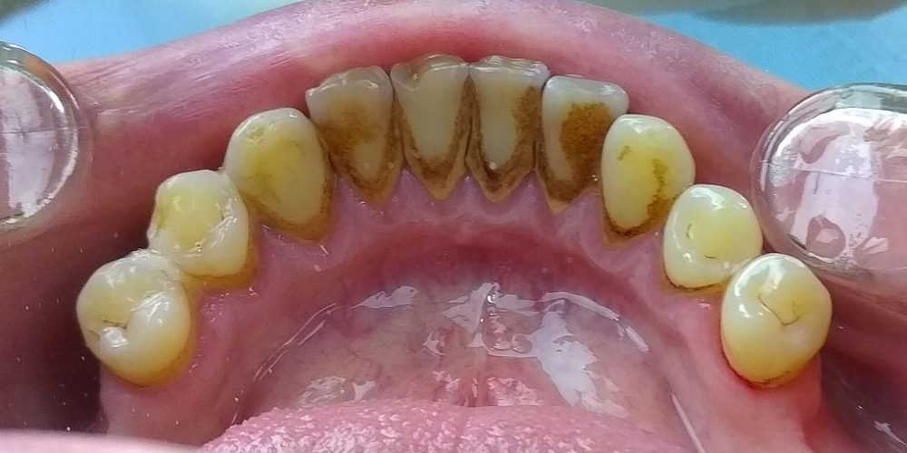 Профессиональная гигиена полости рта, результат чистки зубов - фото №1