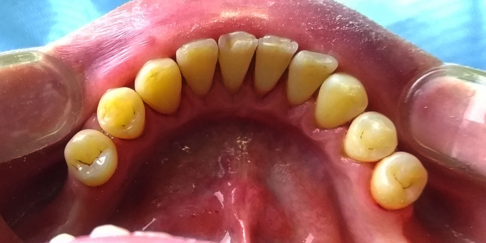 Профессиональная гигиена полости рта, результат чистки зубов - фото №2