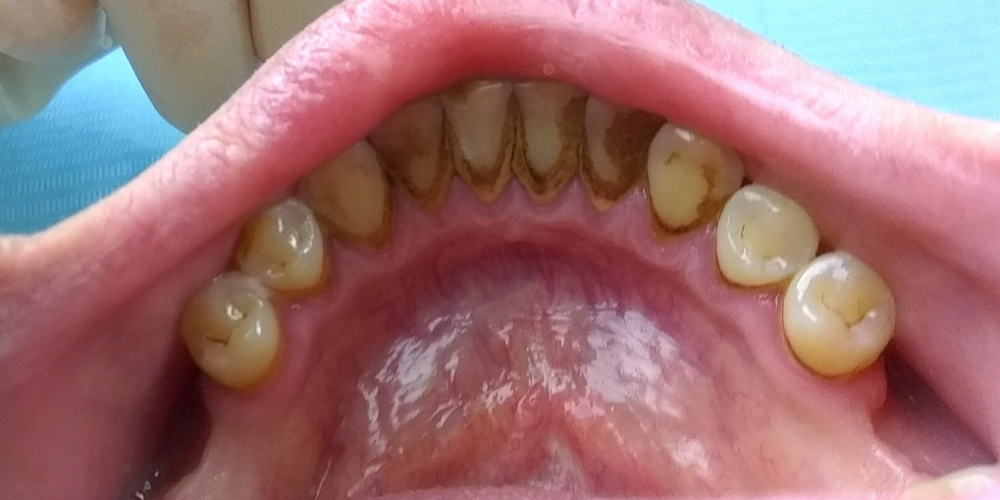 Профессиональная гигиена полости рта, фото до и после - фото №1