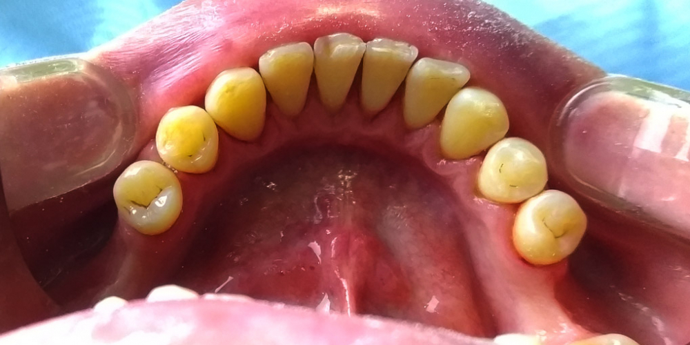 Профессиональная гигиена полости рта, фото до и после - фото №2