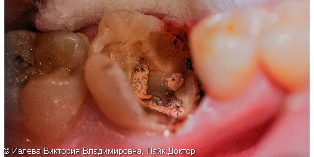 Лечение хронического пульпита зуба 4.6, с последующим протезированием - фото №1