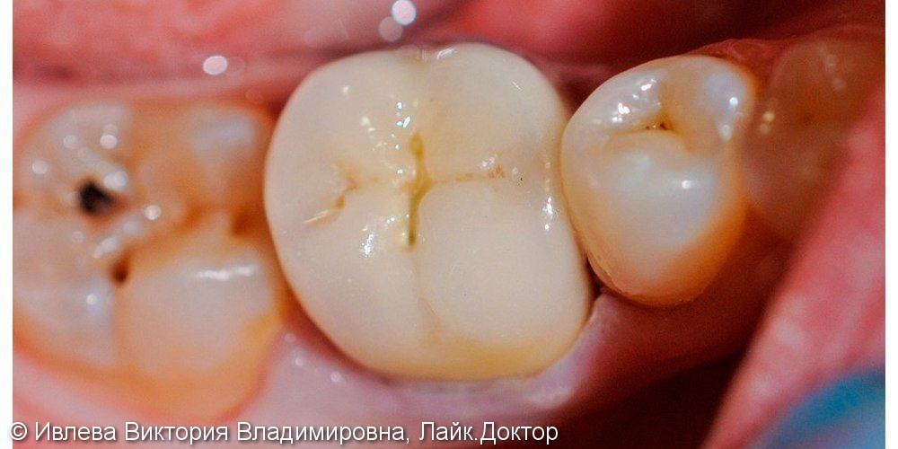 Лечение хронического пульпита зуба 4.6, с последующим протезированием - фото №2